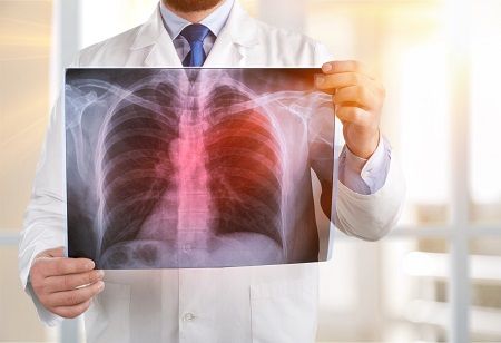 New MRI Dye Could Map Tiny Lung Tumors and Hidden Metastases New MRI Dye Could Map Tiny Lung Tumors and Hidden Metastases India Pharma Outlook