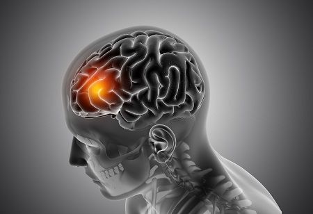Ionis Wins FDA Approval For First Alexander Disease Treatment Ionis Wins FDA Approval For First Alexander Disease Treatment India Pharma Outlook